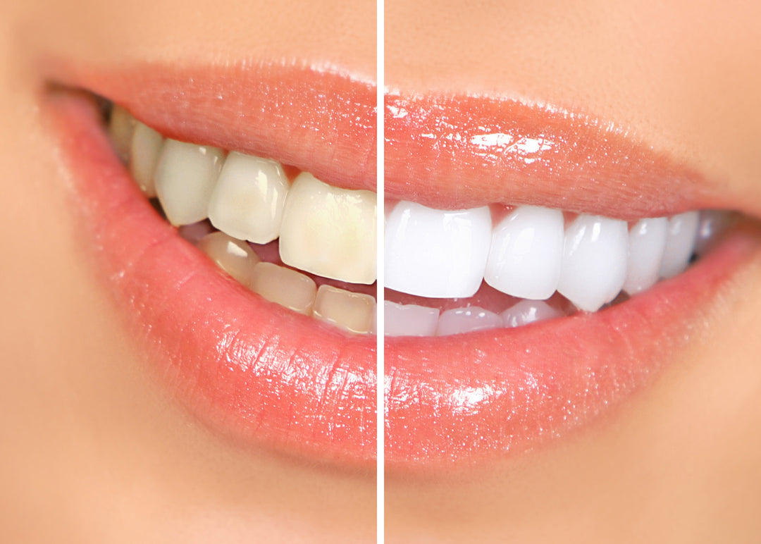 A Complete Guide on How To Whiten Teeth