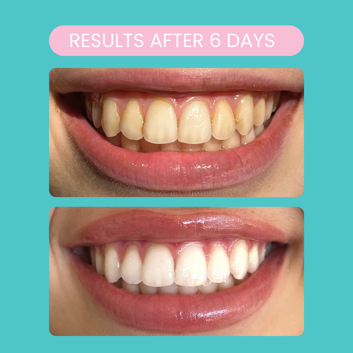 Smilie Ultra Bright Bundle