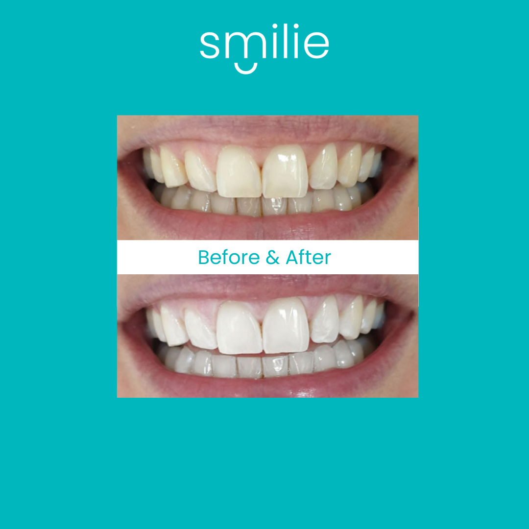 Smilie Super Glow Whitening Toothpaste