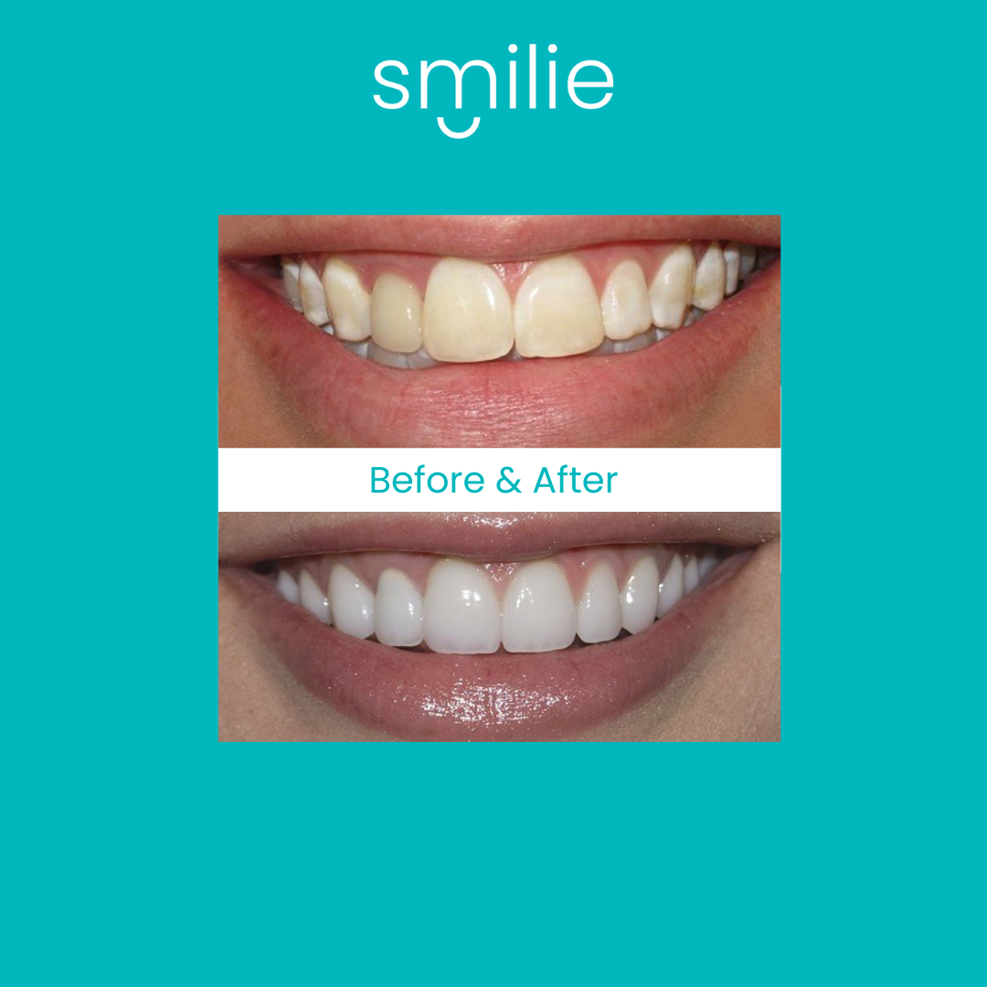 Smilie Super Glow Whitening Toothpaste