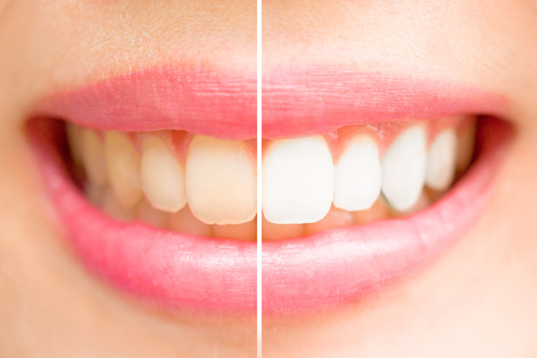Best Teeth Whitening Solutions For Sensitive Teeth