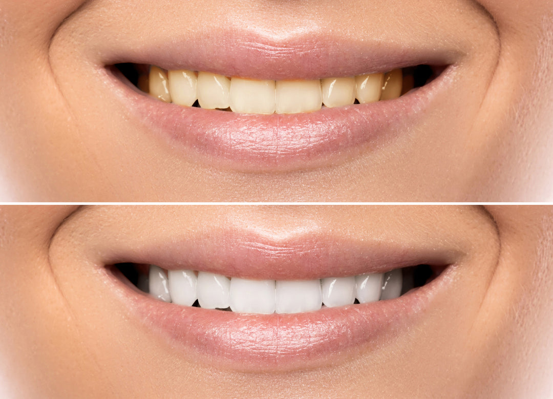 Exploring the Best Teeth Whitening Methods