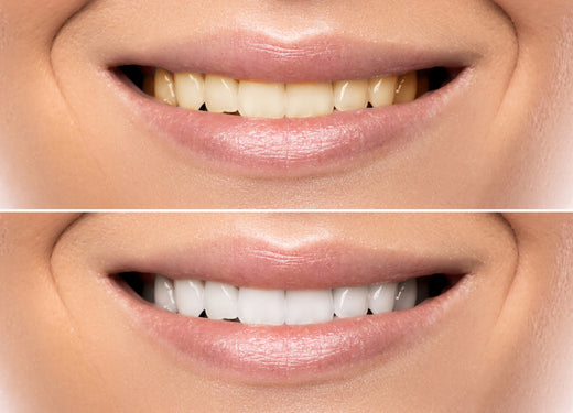 Exploring the Best Teeth Whitening Methods