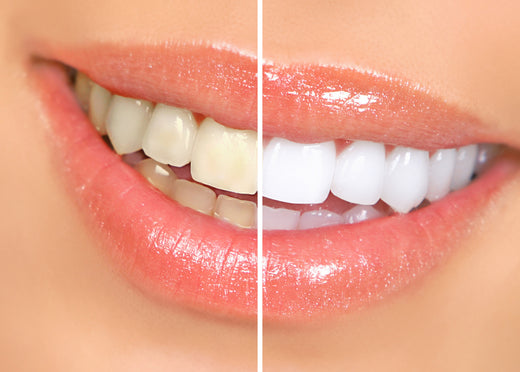 A Complete Guide on How To Whiten Teeth