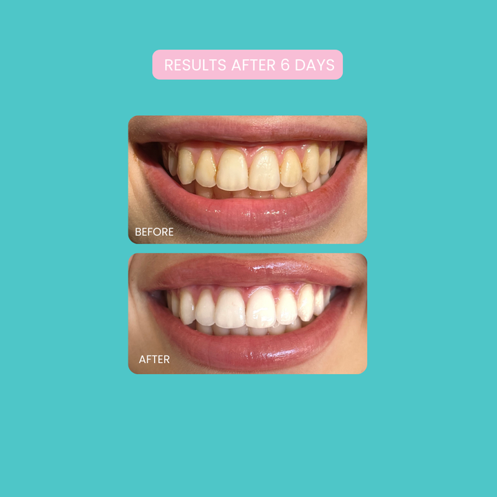 Smilie Boost Teeth Whitening Kit