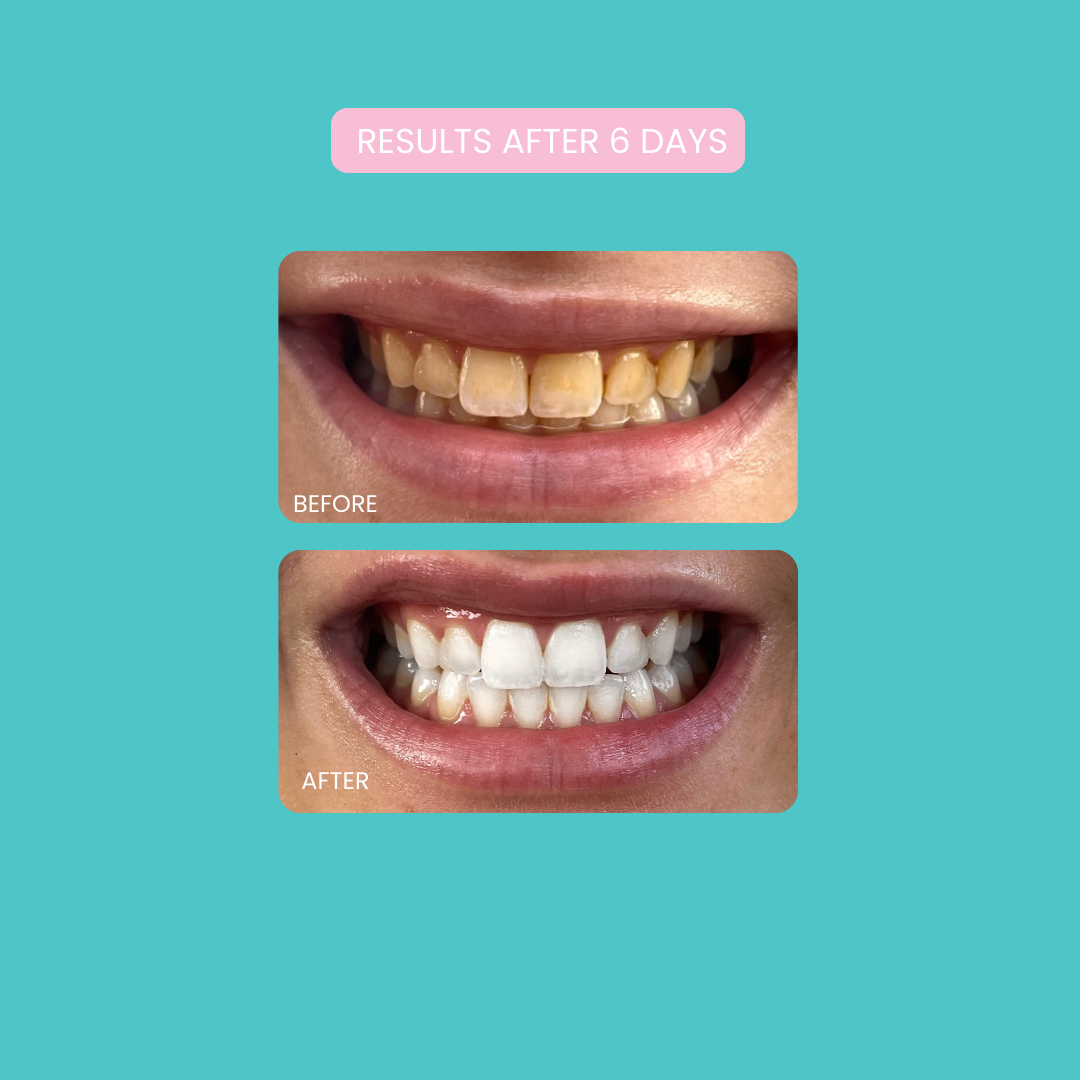 Smilie Boost Teeth Whitening Kit