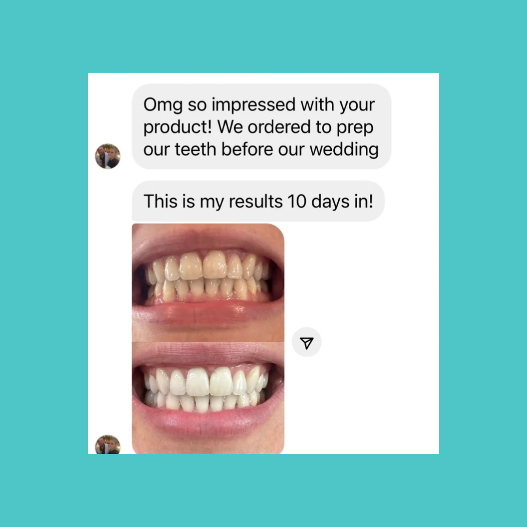 Smilie Teeth Whitening Kit with professional-grade ingredients