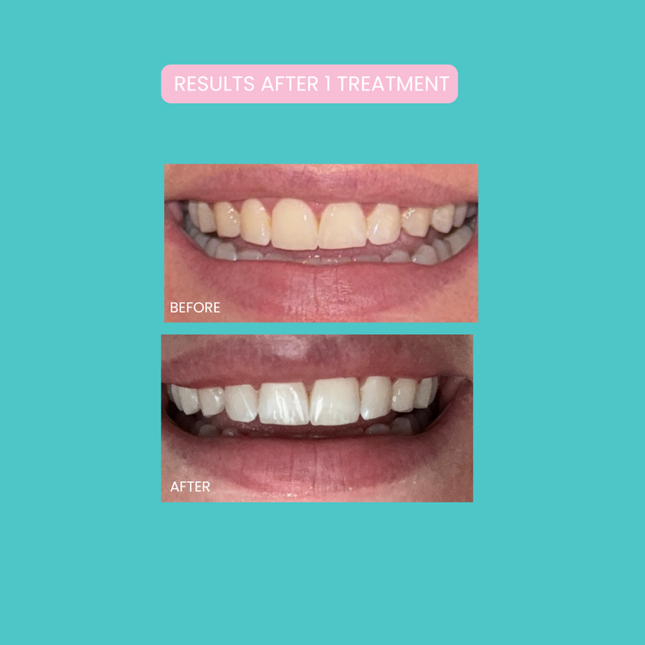 Smilie Boost Teeth Whitening Kit