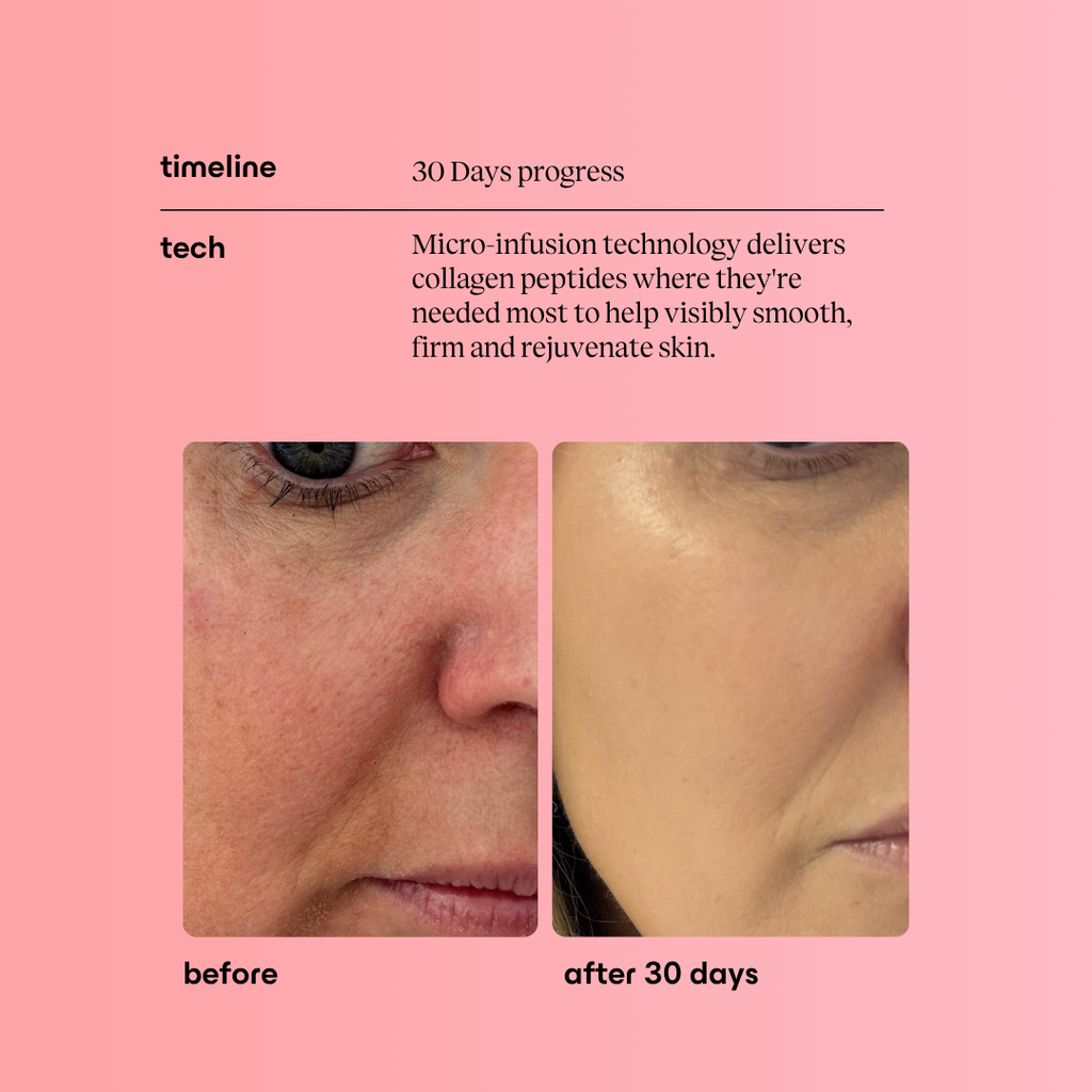 Advanced Peptide Micro-Infusion System