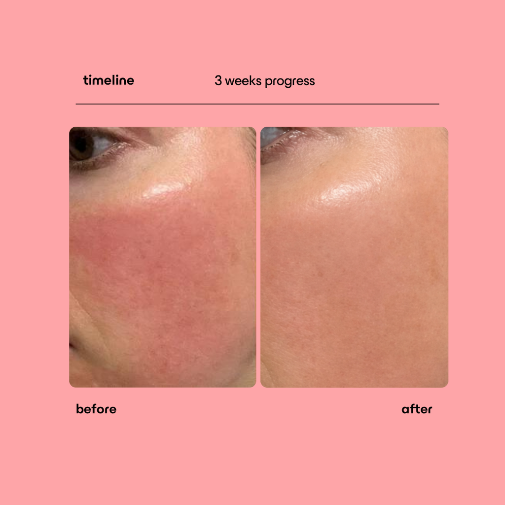 Collagen Peptide Micro-Infusion System