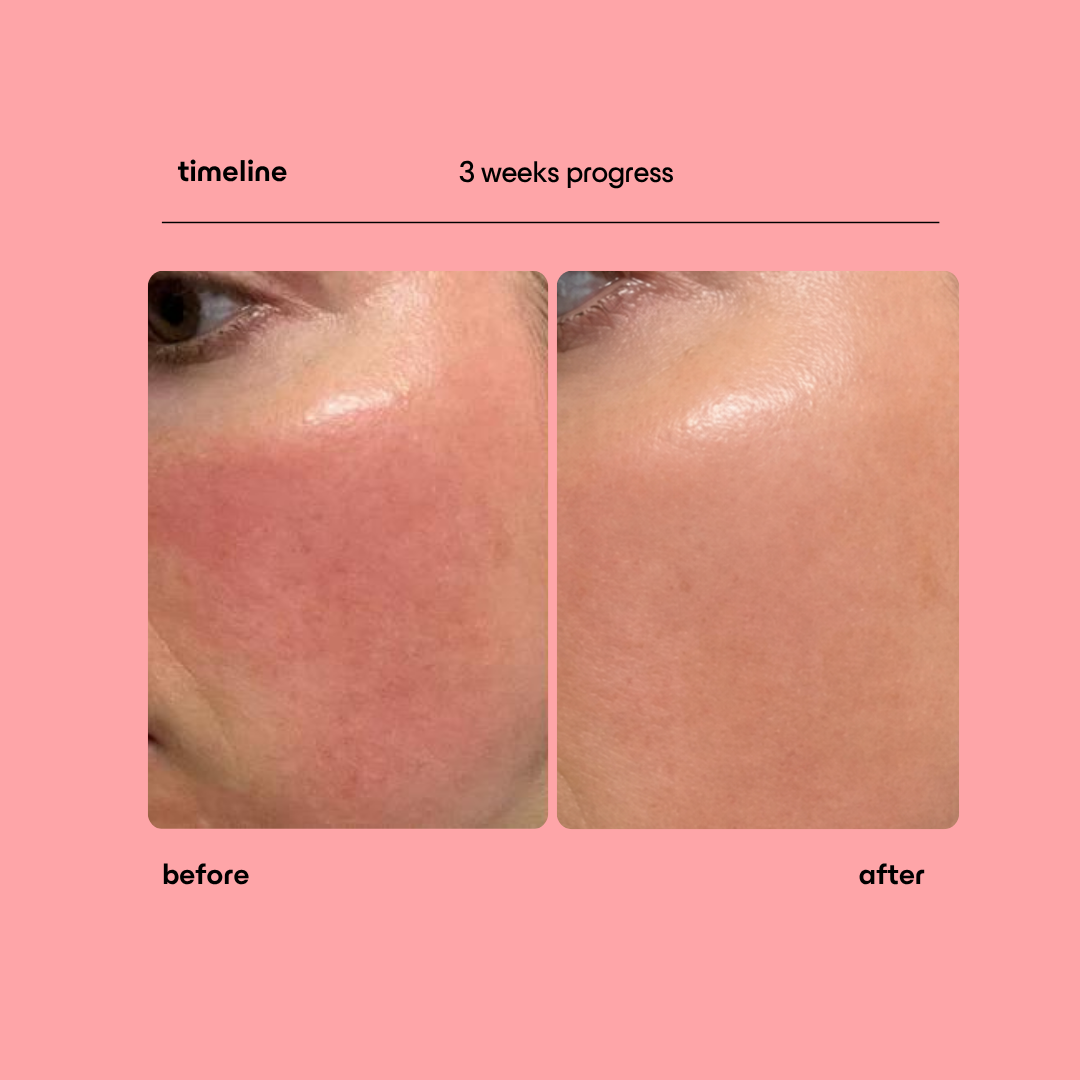 Collagen Peptide Micro-Infusion System