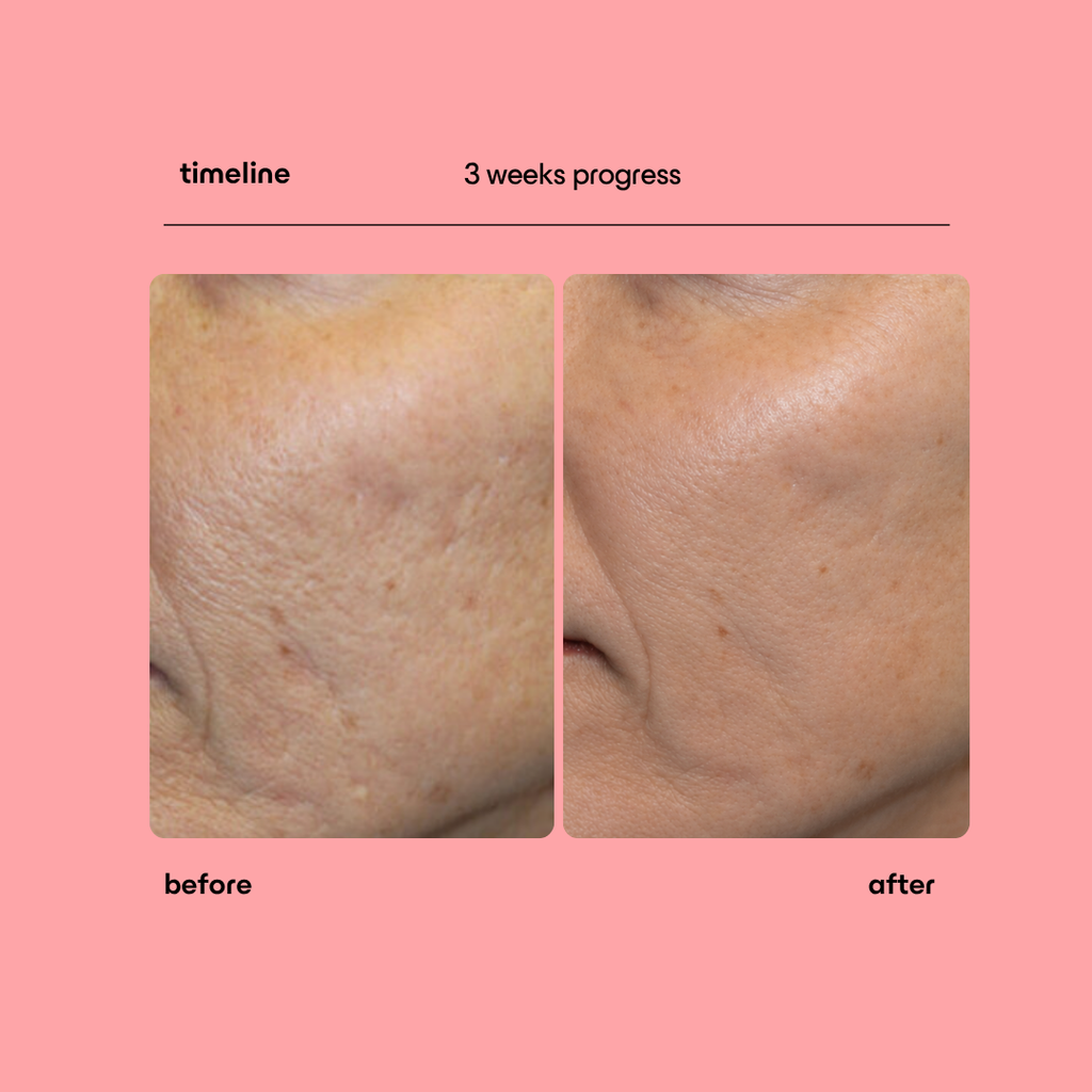 Collagen Peptide Micro-Infusion System