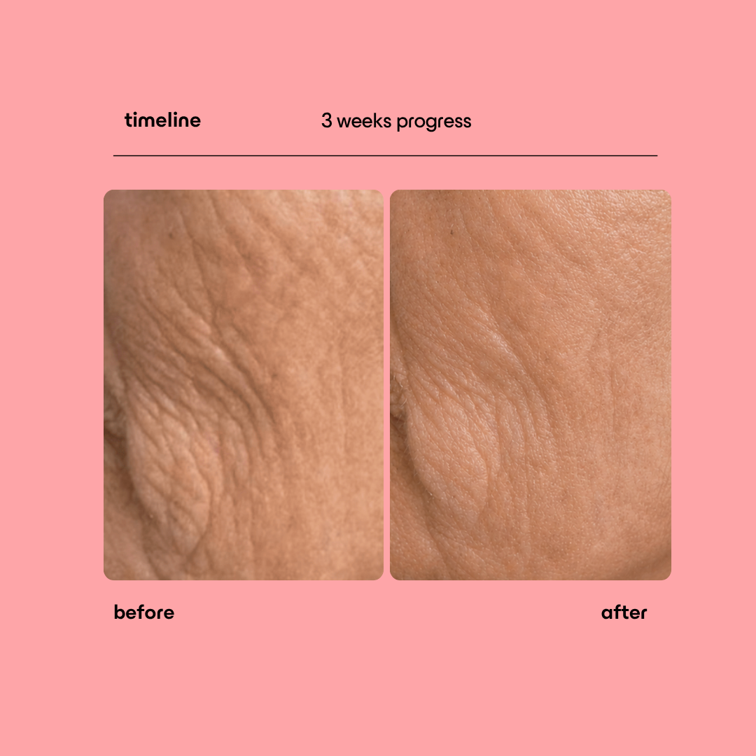 Collagen Peptide Micro-Infusion System