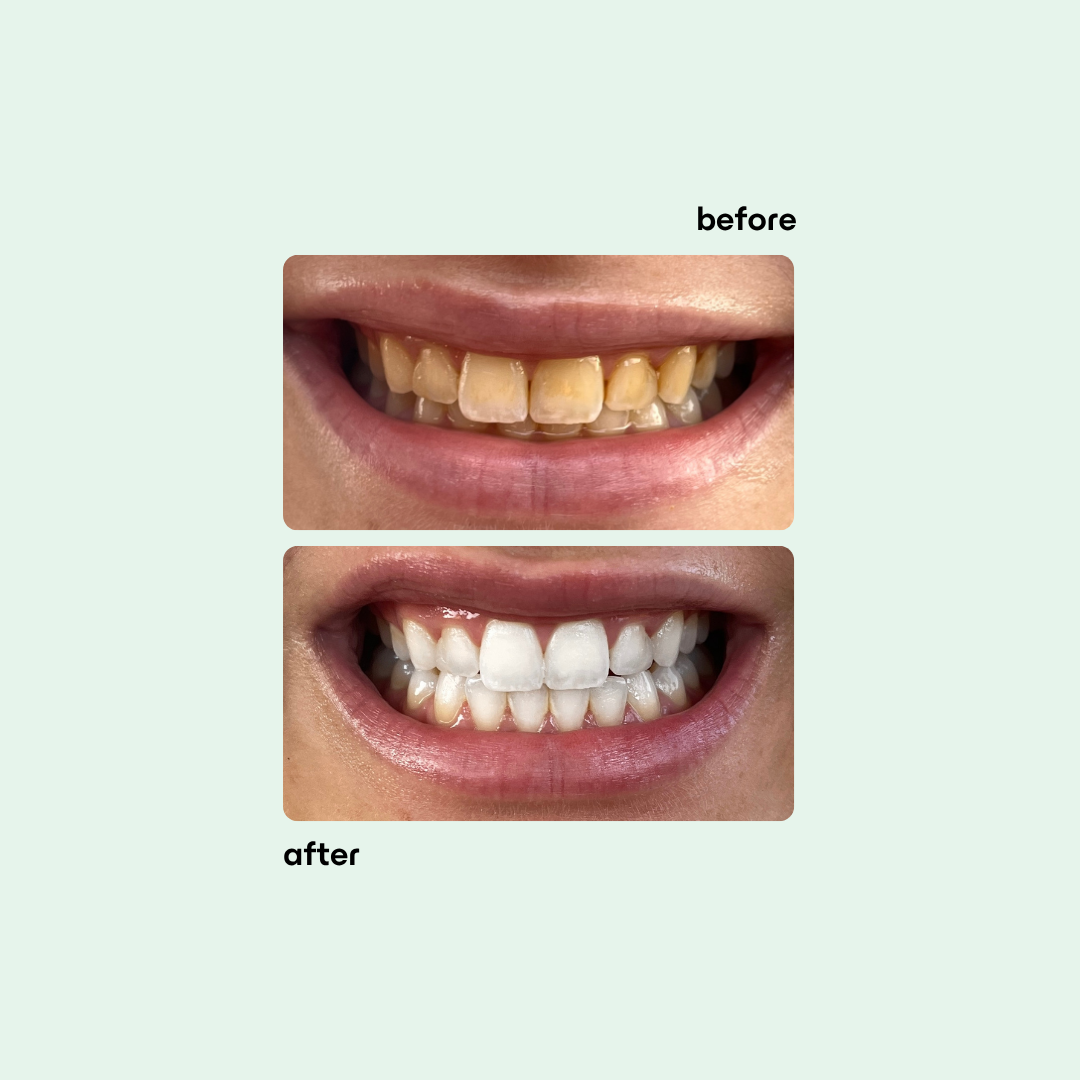 Boost Teeth Whitening Kit