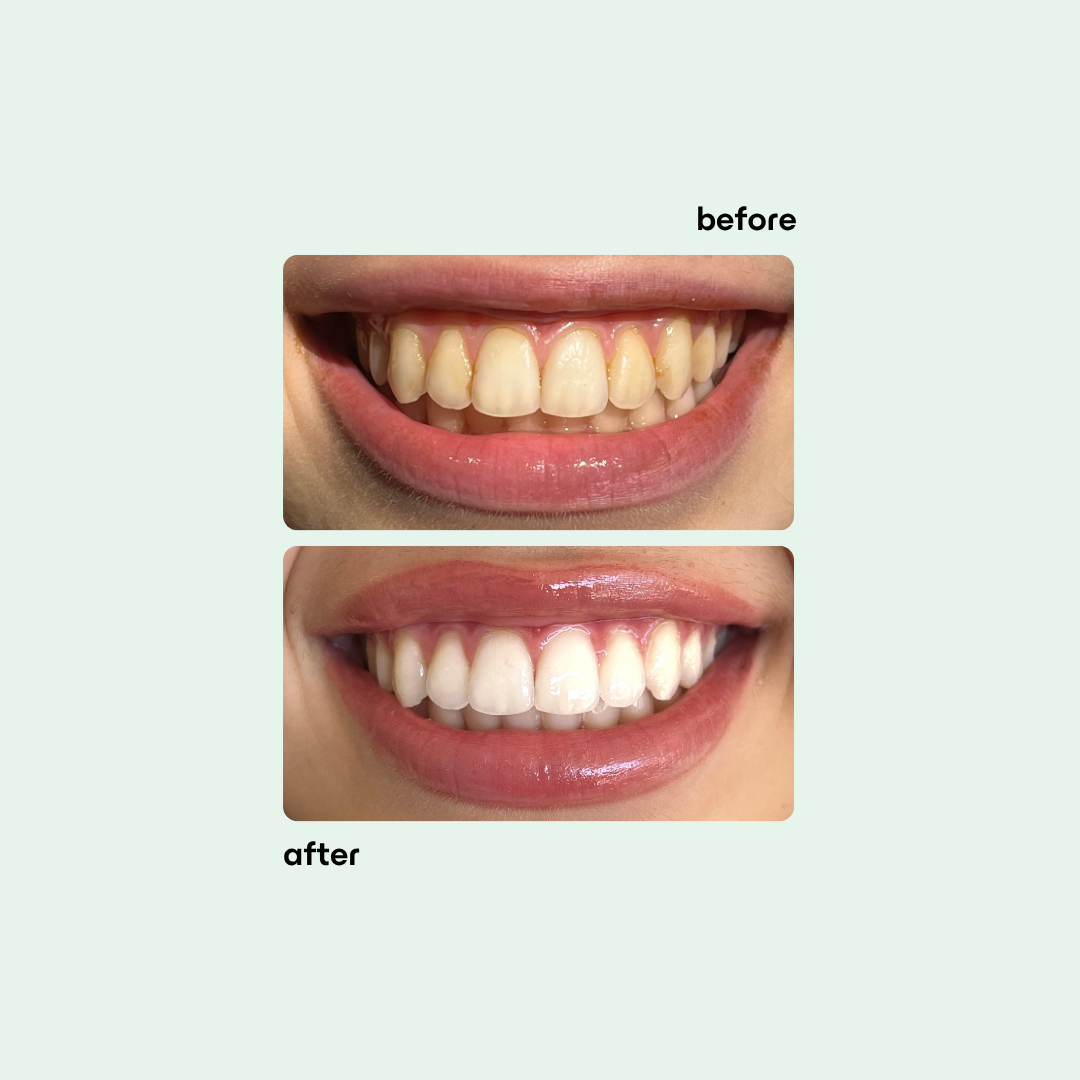 Boost Teeth Whitening Kit