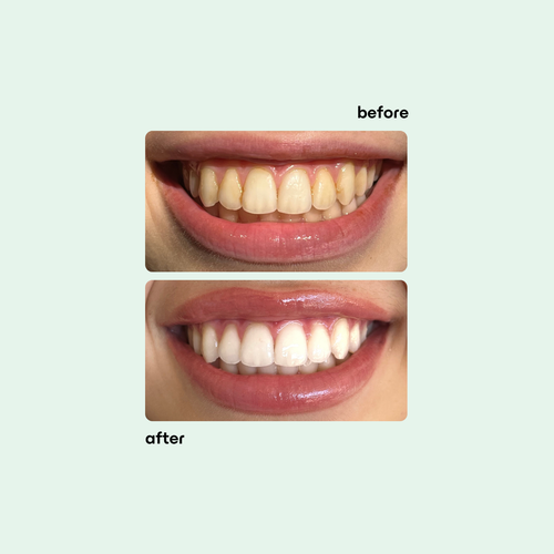 Boost Teeth Whitening Kit