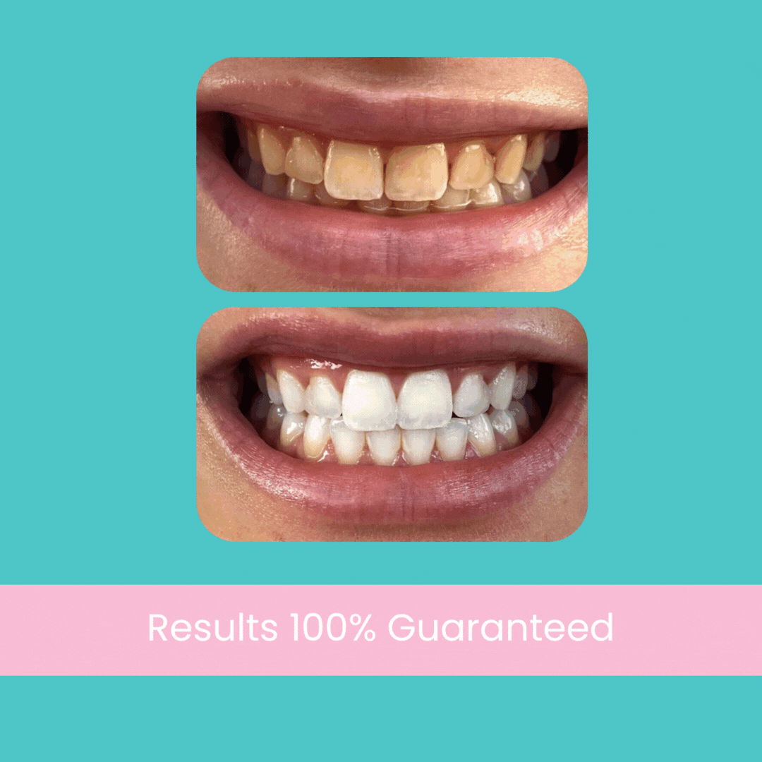 Lápiz Blanqueador Dental Instantáneo WhiteFlash – Happe Market