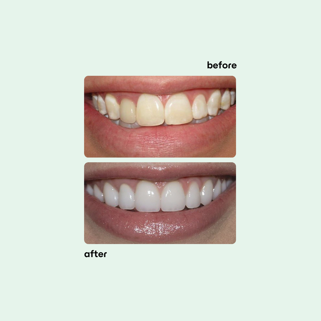 Teeth Whitening Strips